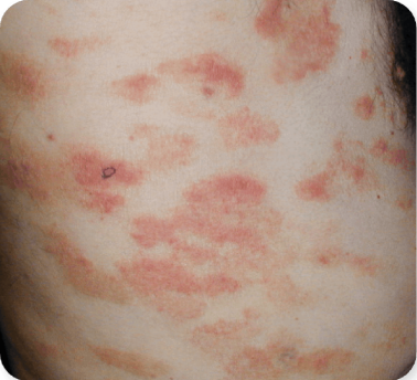 Photograph of Patient 5's skin infection