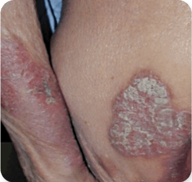 Photograph of Patient 1's skin symptoms, including patches and plaques