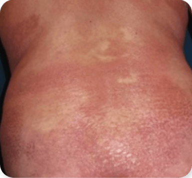 Photograph of Patient 3's patchy lesions