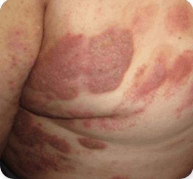 Photograph of Patient 4's skin infection