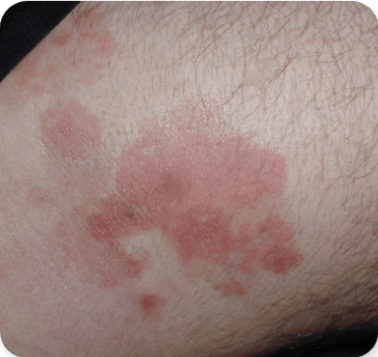 Photograph of Patient 5's skin infection