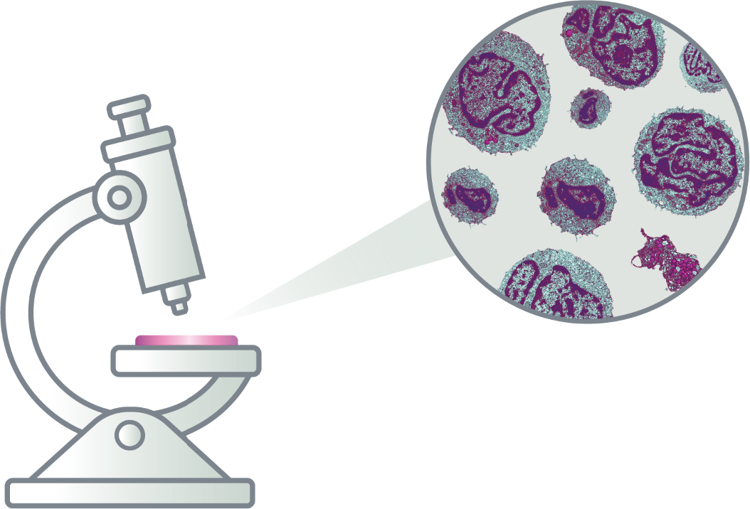 Illustration of a microscope revealing Sézary cells.